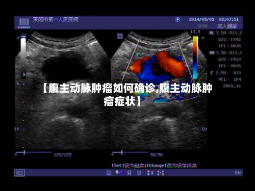【腹主动脉肿瘤如何确诊,腹主动脉肿瘤症状】-第2张图片