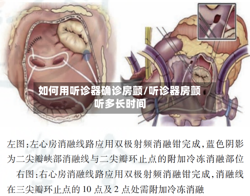 如何用听诊器确诊房颤/听诊器房颤听多长时间