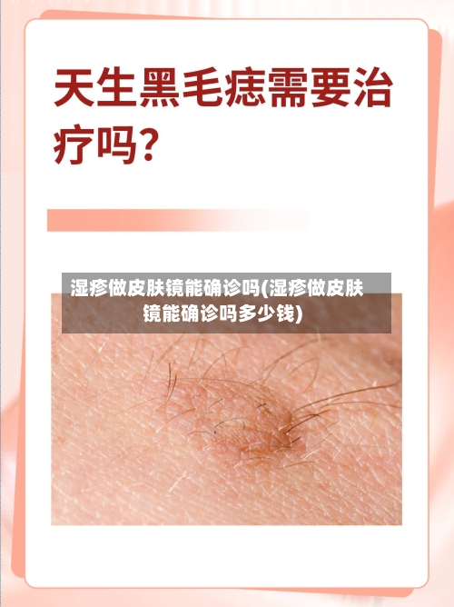 湿疹做皮肤镜能确诊吗(湿疹做皮肤镜能确诊吗多少钱)-第2张图片
