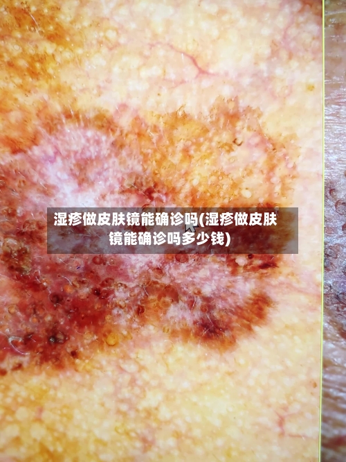 湿疹做皮肤镜能确诊吗(湿疹做皮肤镜能确诊吗多少钱)-第3张图片