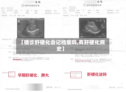 【确诊肝硬化会记档案吗,有肝硬化病史】
