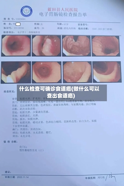 什么检查可确诊食道癌(做什么可以查出食道癌)-第2张图片