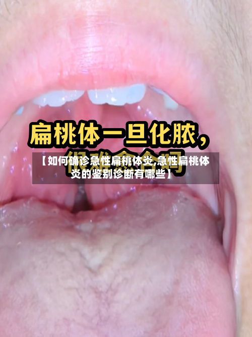 【如何确诊急性扁桃体炎,急性扁桃体炎的鉴别诊断有哪些】