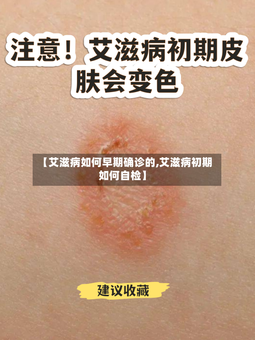 【艾滋病如何早期确诊的,艾滋病初期如何自检】-第2张图片