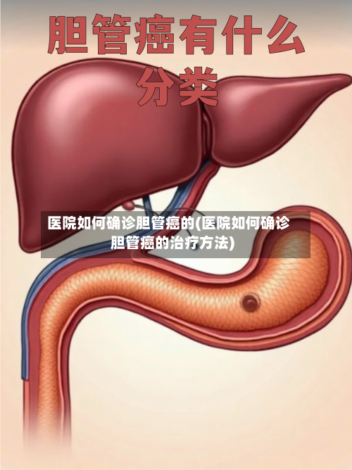 医院如何确诊胆管癌的(医院如何确诊胆管癌的治疗方法)