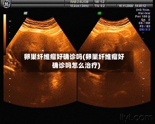 卵巢纤维瘤好确诊吗(卵巢纤维瘤好确诊吗怎么治疗)