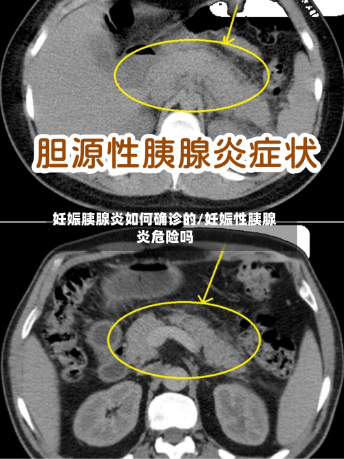 妊娠胰腺炎如何确诊的/妊娠性胰腺炎危险吗-第2张图片