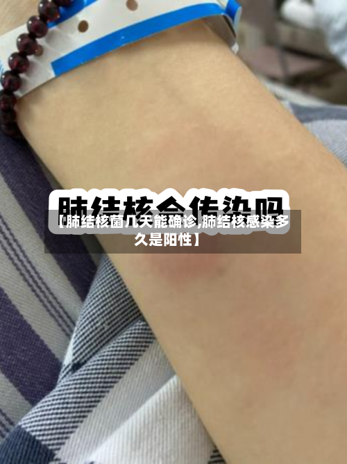【肺结核菌几天能确诊,肺结核感染多久是阳性】-第2张图片