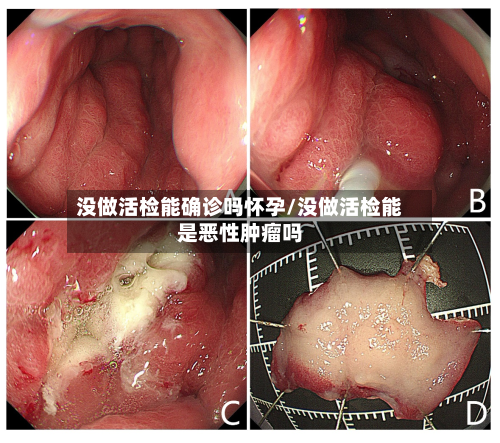 没做活检能确诊吗怀孕/没做活检能是恶性肿瘤吗